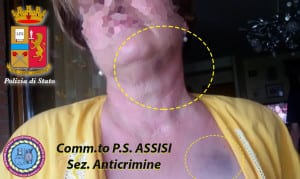 Signora rapina ematoma 2