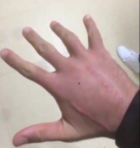 Le condizioni della mano di Petrucci (foto Twitter Petrucci)