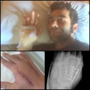 La mano di Petrucci dopo il nuovo infortunio in Qatar a marzo (foto Petrucci)