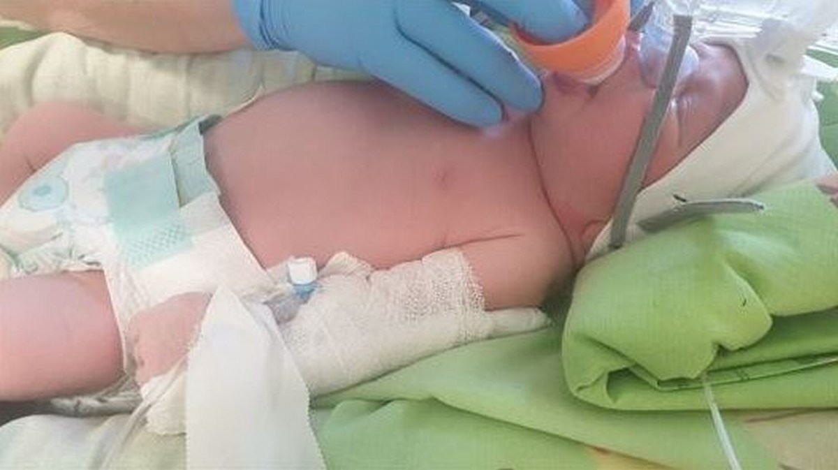 Ventilazione non invasiva su una neonata: prima volta all’ospedale di Foligno